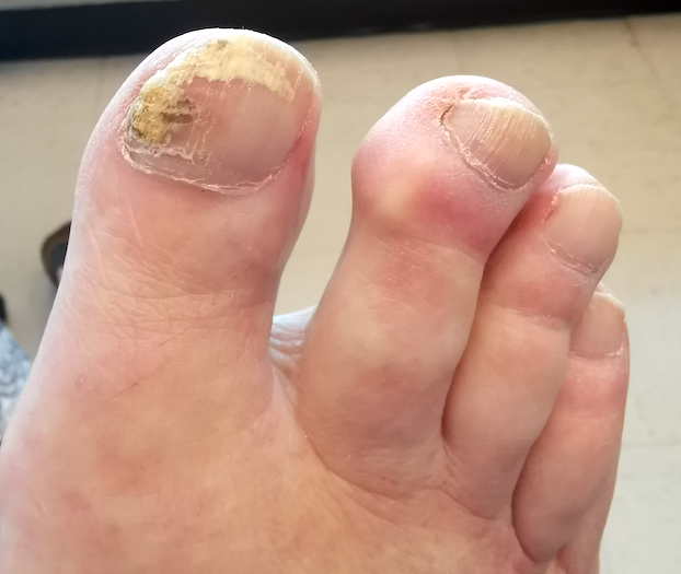 fungal nail testing